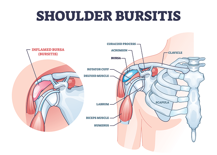 shoulder bursitis